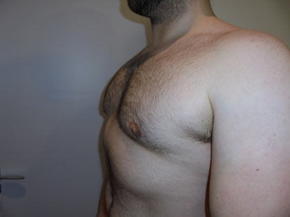 gynaecomastia