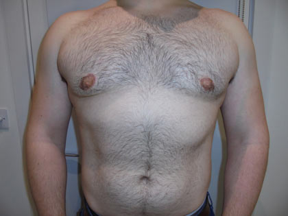 gynaecomastia