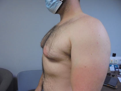 gynaecomastia