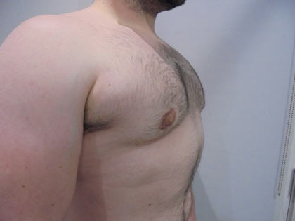 gynaecomastia