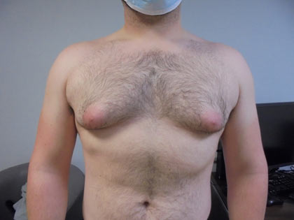 gynaecomastia