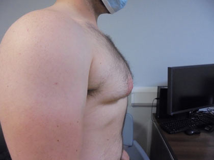 gynaecomastia