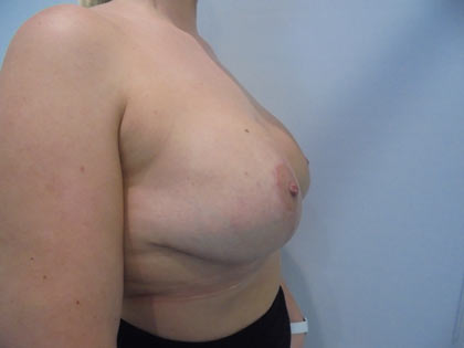 breast reduction