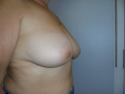 breast reduction