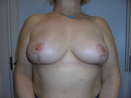 breast reduction