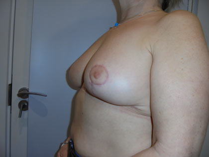 breast reduction