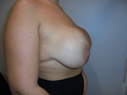 breast reduction