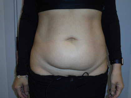 miniabdominoplasty