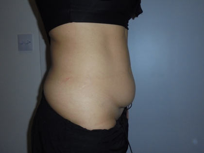 miniabdominoplasty