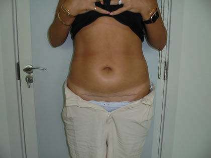 miniabdominoplasty