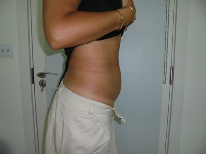 miniabdominoplasty