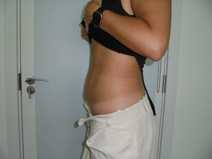 miniabdominoplasty