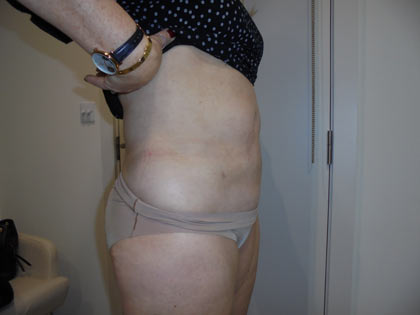 liposuction